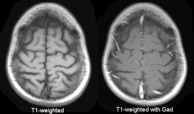 T1 weighted mri blood